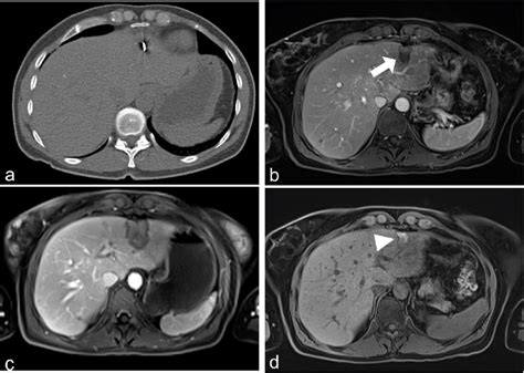 47 Year Old Female Patient With Colorectal Liver Metastasis Who