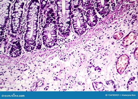 Bacillary Dysentery, Light Micrograph Stock Photography | CartoonDealer.com #232472732