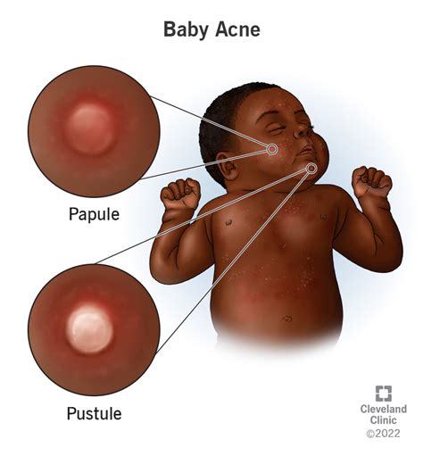 Baby Acne: Causes & Treatments