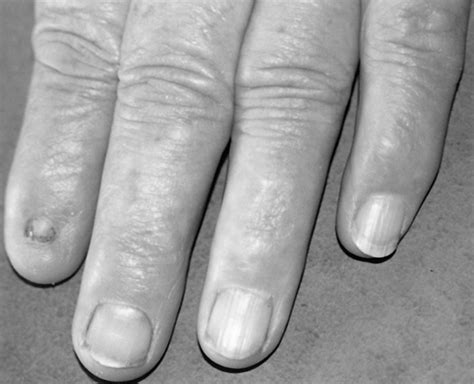 Nail Patella Syndrome A Review Of The Phenotype Aided By Developmental