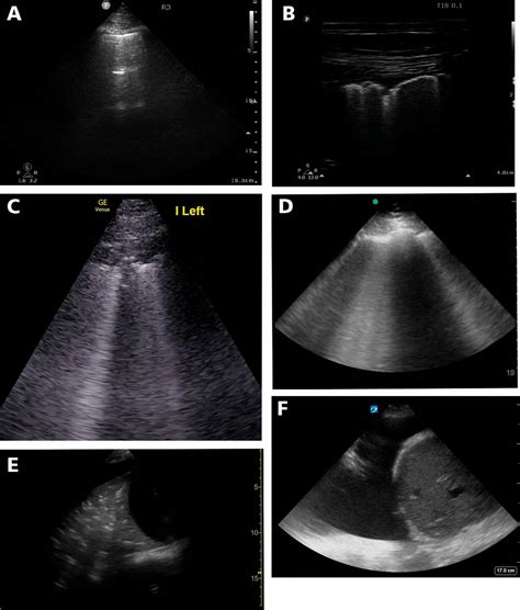 Point Of Care Ultrasound And COVID 19 Cleveland Clinic Journal Of