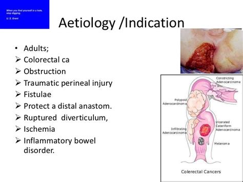 Colostomy