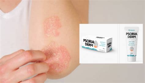 PsoriaDerm Gel De Hierbas Para La Psoriasis Opiniones Y Precio