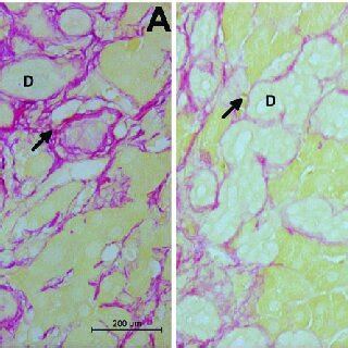 Representative Microphotographs Of Liver With Biliary Fibrosis In The