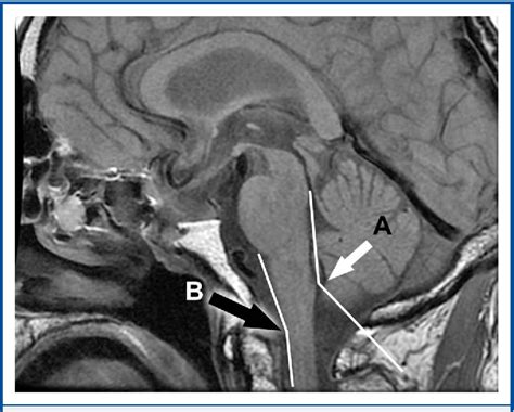 Figure 3 from The Aqueduct of Sylvius: Applied 3-T Magnetic Resonance Imaging Anatomy and ...