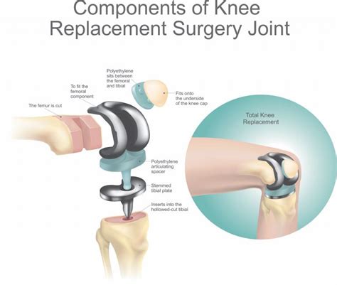 Vancouver Hip And Knee Replacement Institute Vancouver Hip And Knee Institute Vancouver Bc