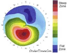 Corneal Topography