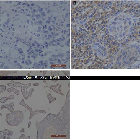 Representative Photographs Of Pd L Immunostaining In Esophageal