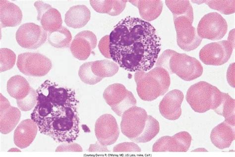 Hematology Leukocyte Disorders Flashcards Quizlet