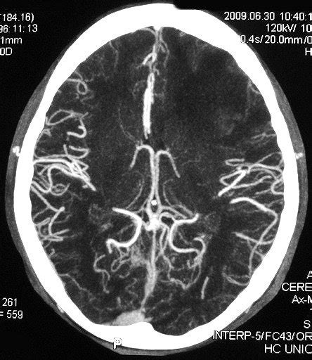 Exame de angiotomografia do crânio do preparo ao procedimento