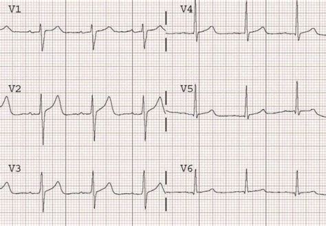 T Wave • Litfl • Ecg Library Basics