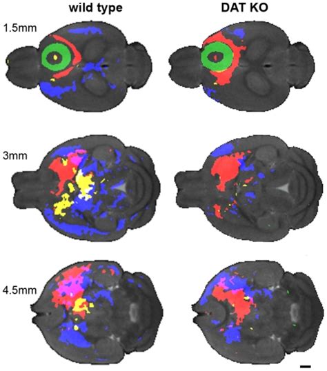 Representative Transverse Sections Through The Statistical Parametric