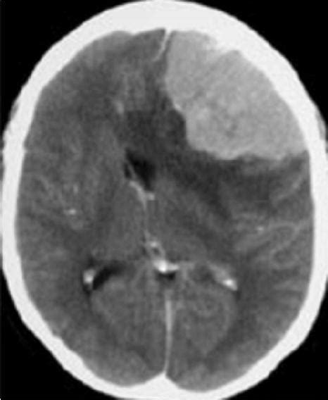 Preoperative Endovascular Embolization Of Meningiomas Update On