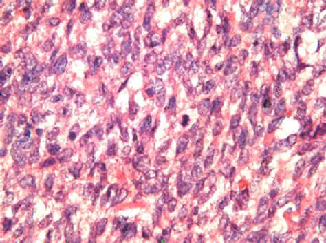 Figure 1 From Itotically Active Cellular Fibroma Of Ovary Should Be Differentiated From