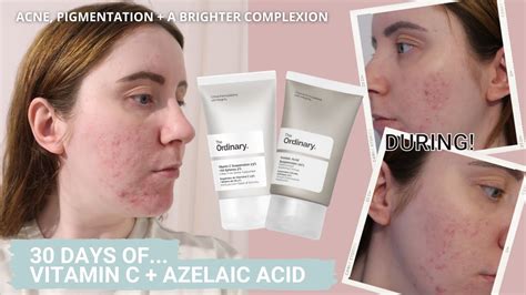 Azelaic Acid Before And After