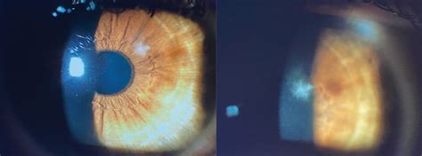 Understanding Corneal Ulcers And Infiltrates