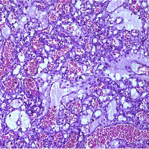 Histopathologic Examination Showing Small Vascular Spaces Lined With