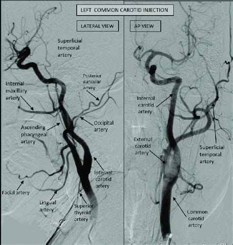 Branches Of Internal Carotid Artery