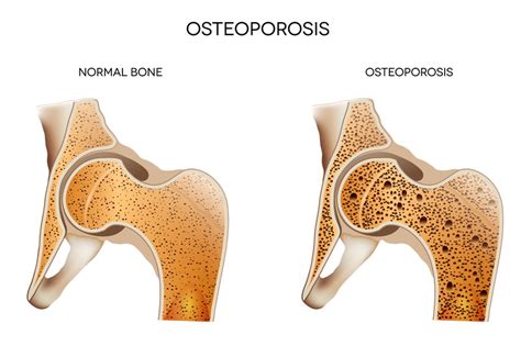 Hormone Therapy And Accelerated Bone Loss in Aging Men and Women ...