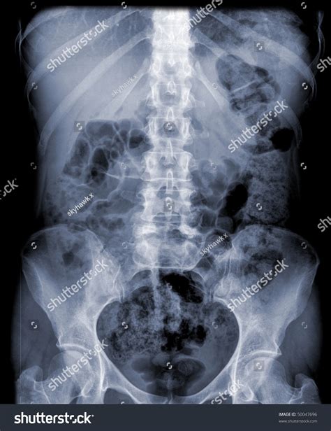 Abdomen Fos X Ray Stock Photo Shutterstock