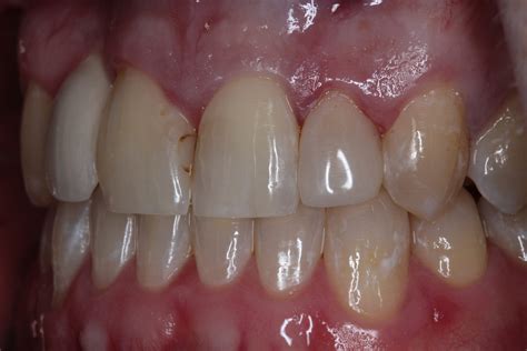 Case Study How To Fix Small Teeth With Peg Lateral Treatment