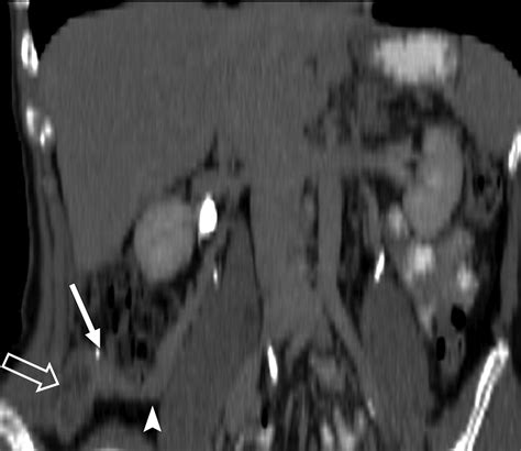 Detection Of The Gonadal Veins In The Diagnosis Of Transposed Ovaries