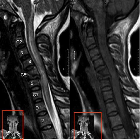 23 Sci Associated With A Flexion Teardrop Fracture Sagittal T1 And