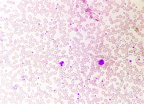 Trombocitosis Frotis De Sangre Que Muestra Un Alto Volumen Anormal De Análisis De Plaquetas Por