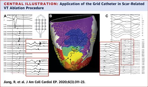 High Density Grid Catheter For Detailed Mapping Of Sinus Rhythm And