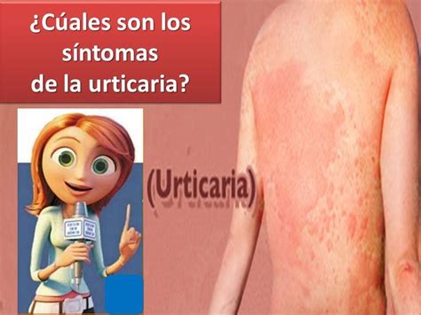 Urticaria Cuales Los Sintomas Youtube