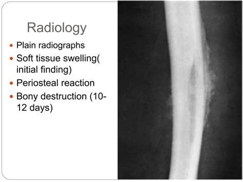 Acute Hematogenous Osteomyelitis Ppt