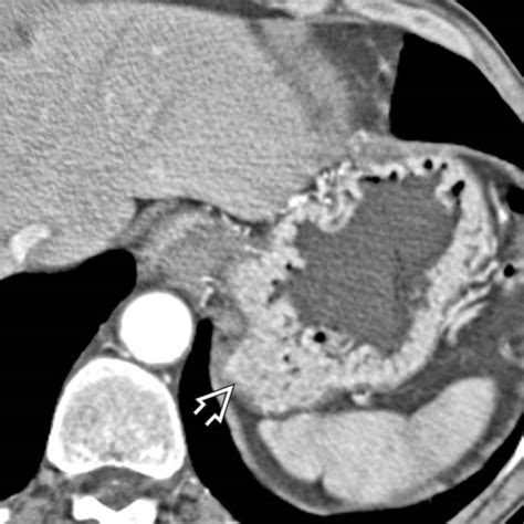 Zollinger-Ellison Syndrome | Clinical Gate