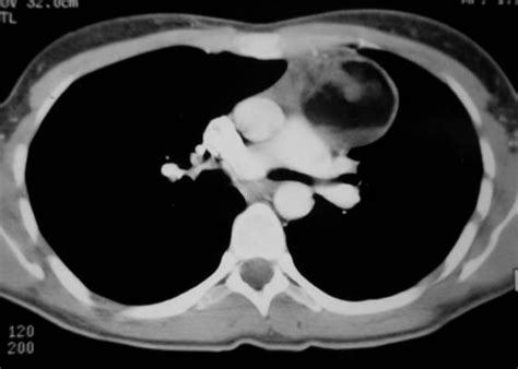 Mature Mediastinal Teratoma Eurorad