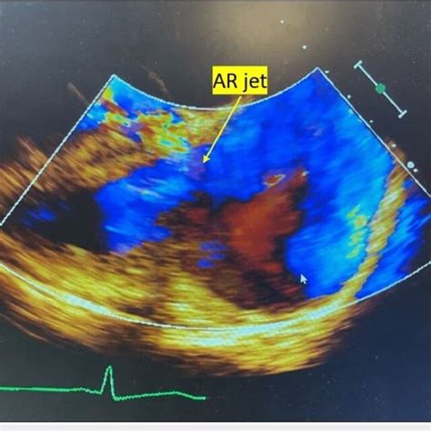 Transthoracic Echocardiography Showing Aortic Insufficiency Download Scientific Diagram