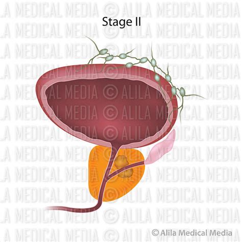 Alila Medical Media Stage Of Prostate Cancer Medical Illustration