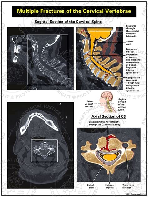 Multiple Fractures of the Cervical Vertebrae