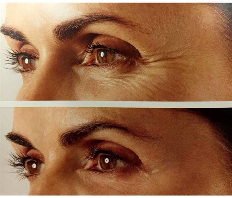 Botox Before And After Crows Feet Photo Botox Face Botox Botox