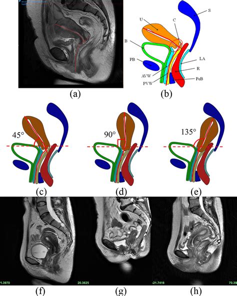 A Shows The MR Image Of The Normal Pelvic Floor System In The Median