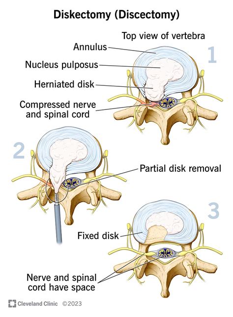 Diskectomy: What It Is, Purpose, Procedure & Recovery