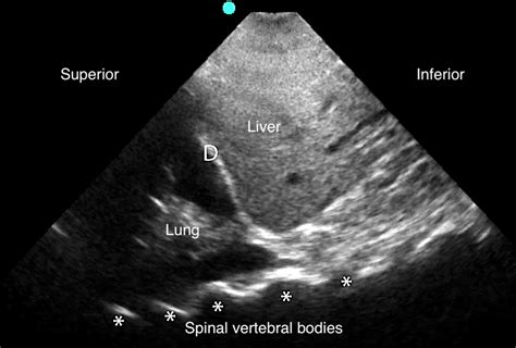 Lung Sonoguide