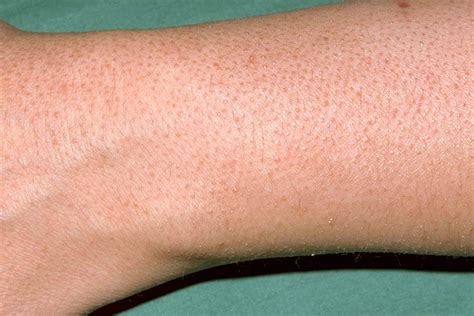 How To Get Rid Of Keratosis Pilaris La Fuji Mama