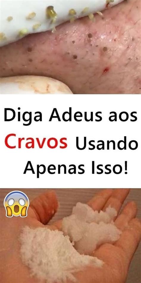 Faça ISSO Para Remover Cravos do Nariz PASTA DE DENTE Cravos e