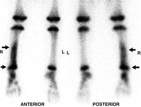 Osteomyelitis Bone Scan