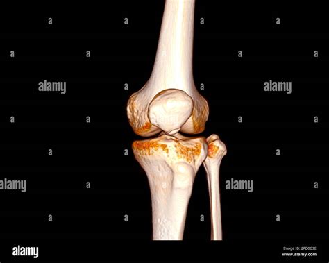 Ct Scan Of Knee Joint D Rendering Stock Photo Alamy