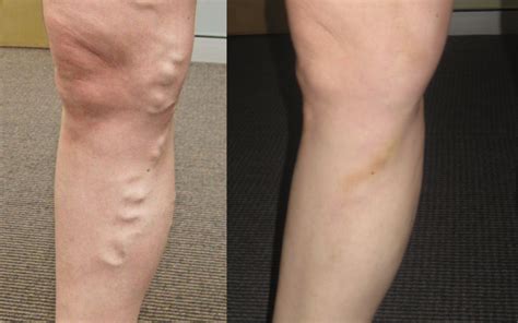 Varicose Vein Treatment Adelaide Vein Treatment Clinic Adelaide