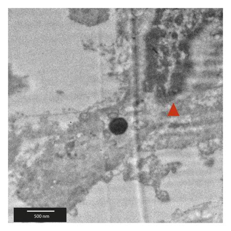 Transmission Electron Microscopy TEM Of A Section Of A Human AP