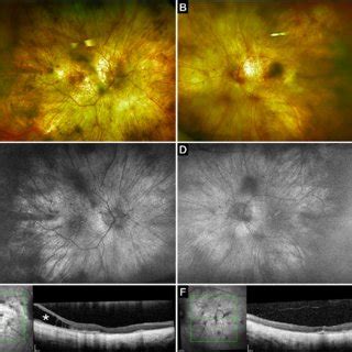 Multimodal Imaging Of Case A B Optos Fundus Photographs Reveal