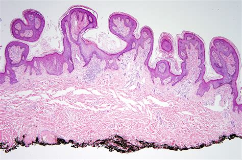 Epidermal Nevus