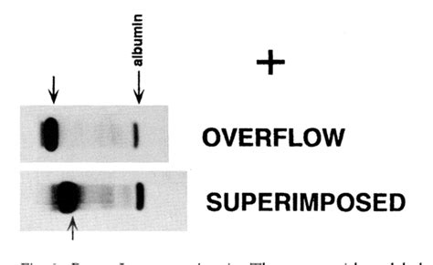 Figure From Urine Protein Electrophoresis And Immunofixation