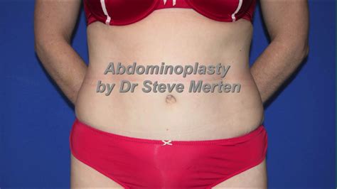 Abdominoplasty Before And After Morph Video Youtube